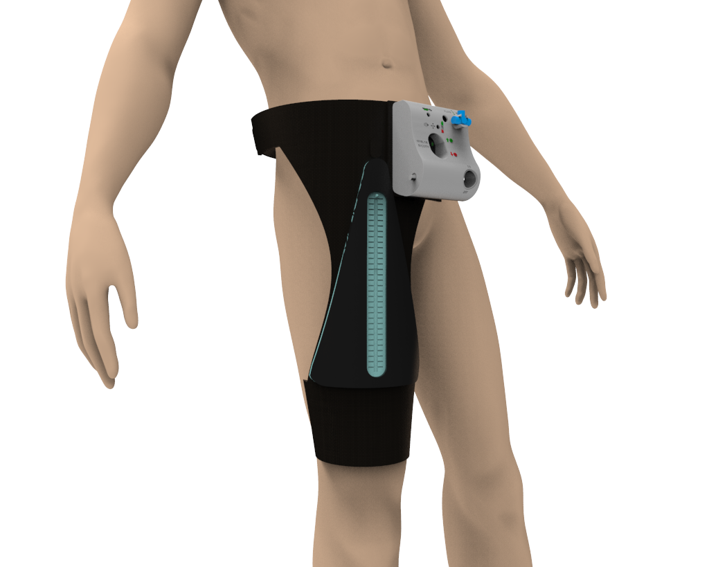 Image of the portable therapeutic pleural drainage device. 