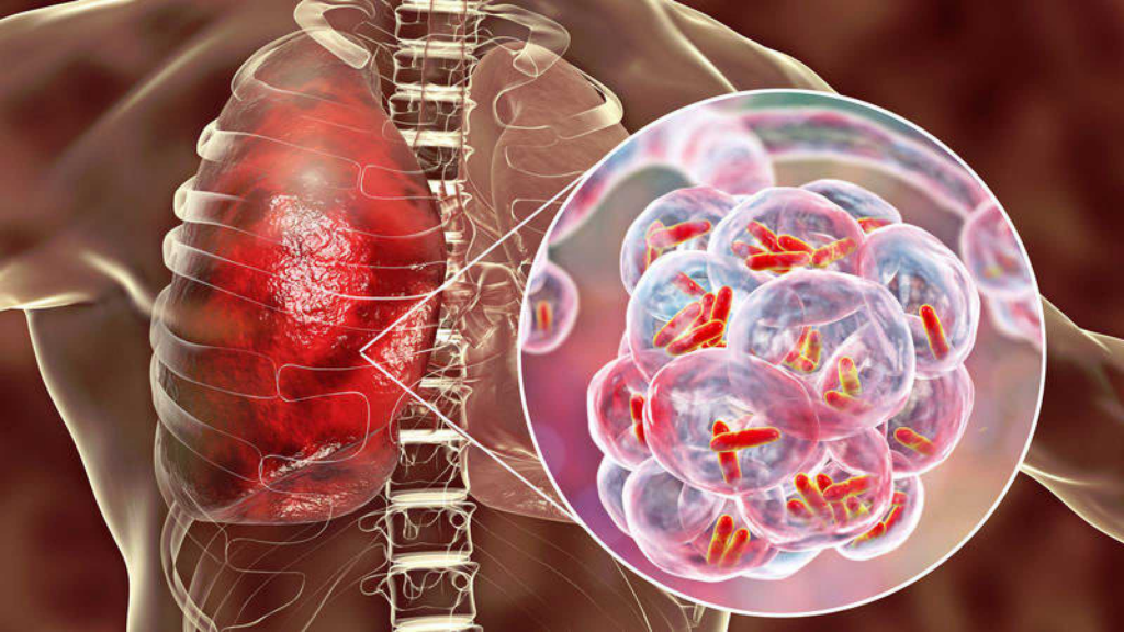 Imagen de persona con tuberculosis 